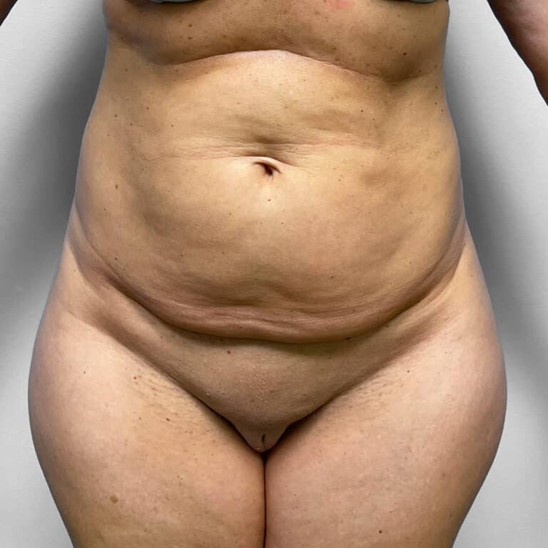 Before Image: Tummy Tuck & Lipo – Dr. Tucker - front