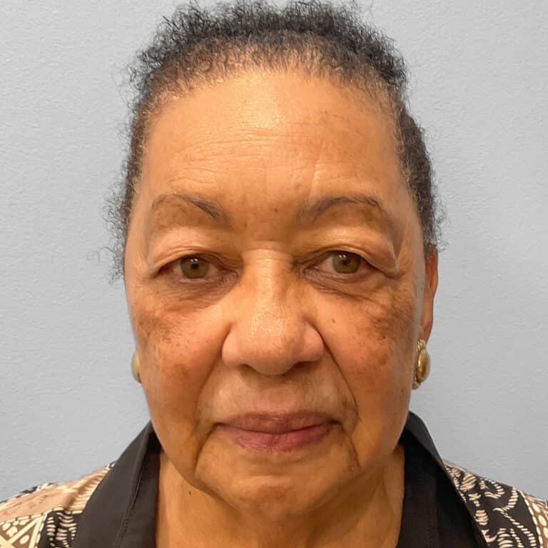 Before Image: Upper Blepharoplasty – Dr. Tucker - front