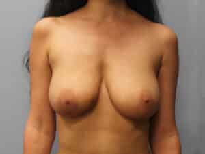 Before Image: Breast Reconstruction – Dr. Tucker
