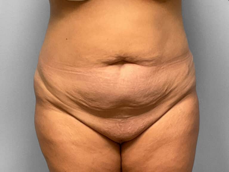 Before Image: Abdominoplasty & Lipo – Dr. Tucker - front
