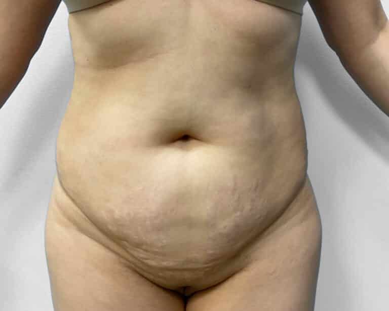 Before Image: Tummy Tuck, BBL, & Lipo – Dr. Tucker - front
