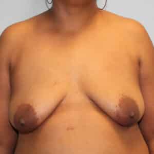Before Image: Breast Reconstruction – Dr. Tucker