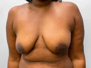 Before Image: Breast Augmentation & Lift – Dr. Tucker