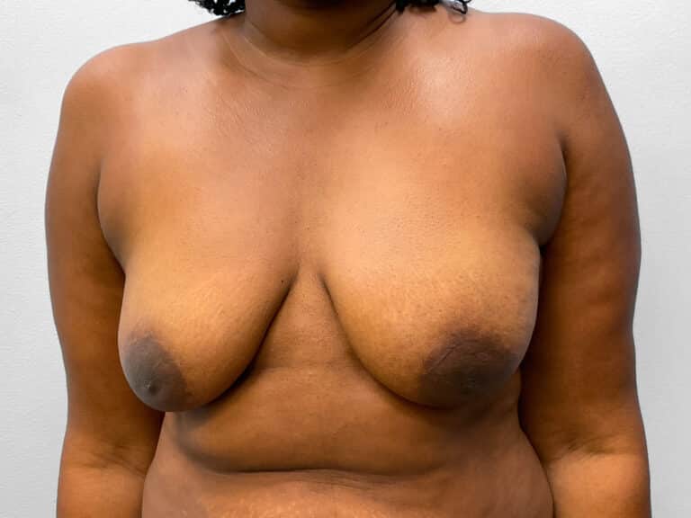 Before Image: Breast Augmentation & Lift – Dr. Tucker - front