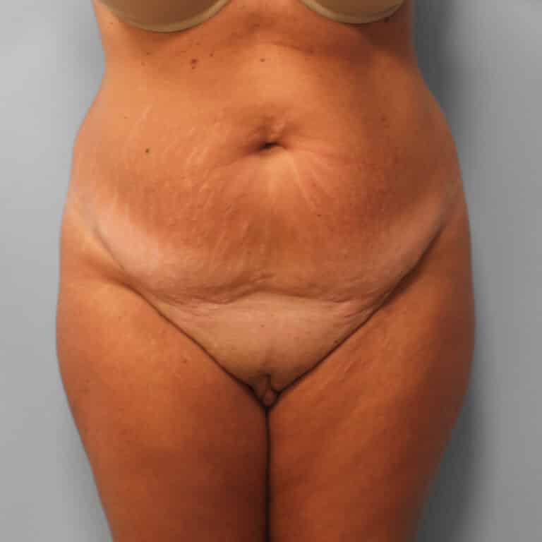 Before Image: Tummy Tuck & Lipo – Dr. Tucker - front