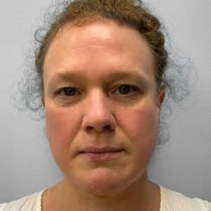 Before Image: Upper Blepharoplasty – Dr. Tucker