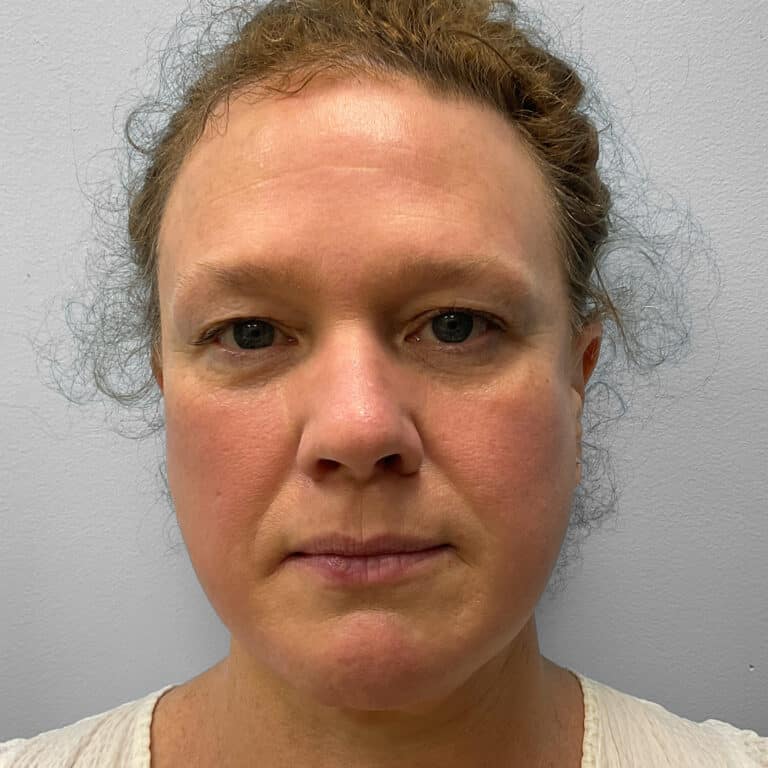 Before Image: Upper Blepharoplasty – Dr. Tucker - front