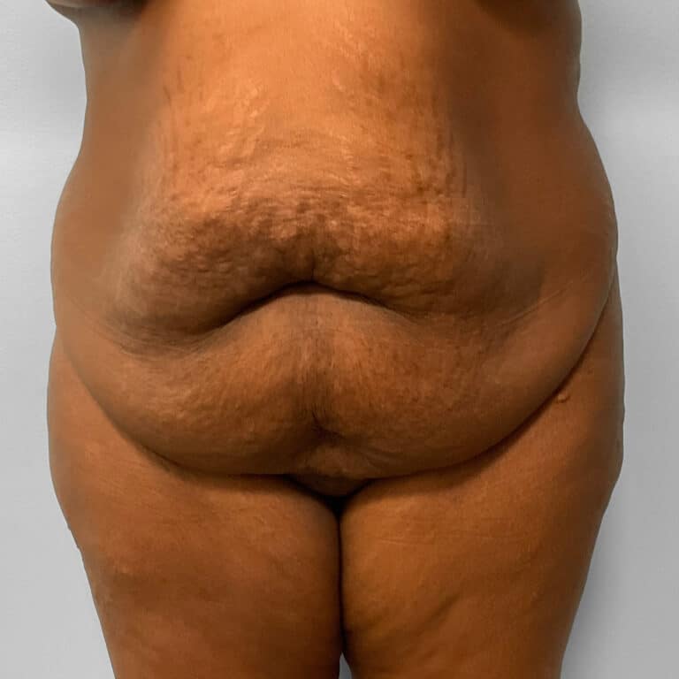 Before Image: Abdominoplasty & Lipo – Dr. Tucker - front