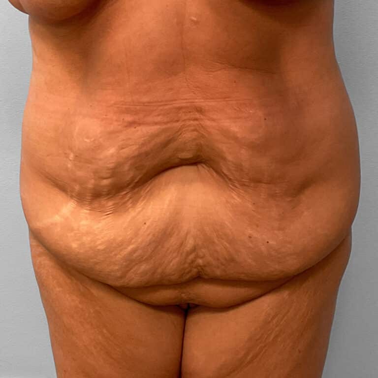 Before Image: Tummy Tuck & Lipo – Dr. Tucker - front