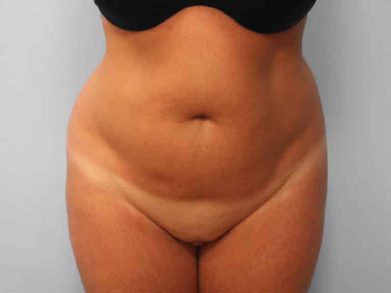 Before Image: Abdominoplasty & Lipo – Dr. Tucker - front