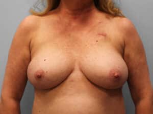 Before Image: Breast Reconstruction – Dr. Tucker