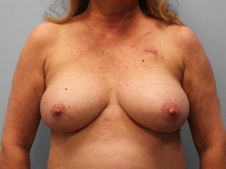 Before Image: Breast Reconstruction – Dr. Tucker - front