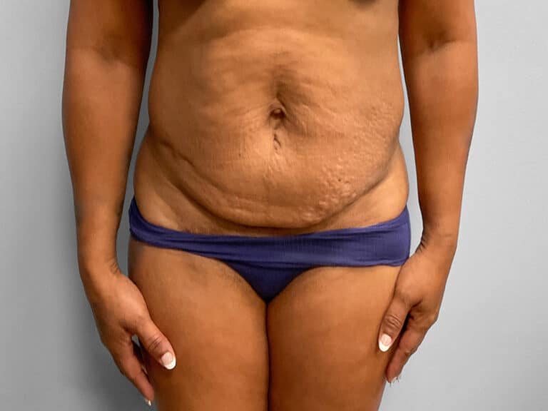 Before Image: Tummy Tuck & Lipo – Dr. Tucker - front