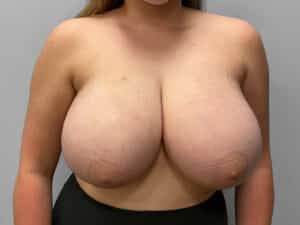 Before Image: Breast Reduction – Dr. Tucker