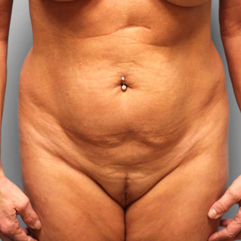 Before Image: Mini Tummy Tuck & Lipo – Dr. Tucker - front