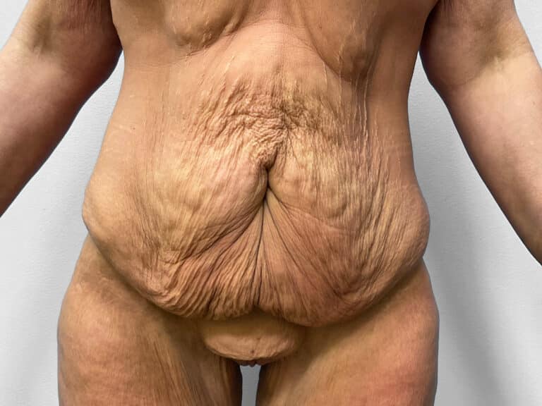 Before Image: Body Lift – Dr. Tucker - front