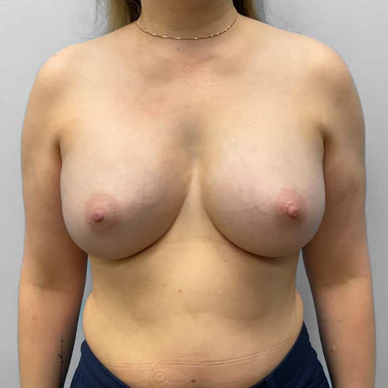Before Image: Breast Augmentation – Dr. Tucker - front