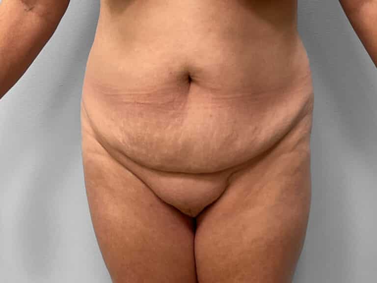 Before Image: Tummy Tuck & Lipo – Dr. Tucker - front