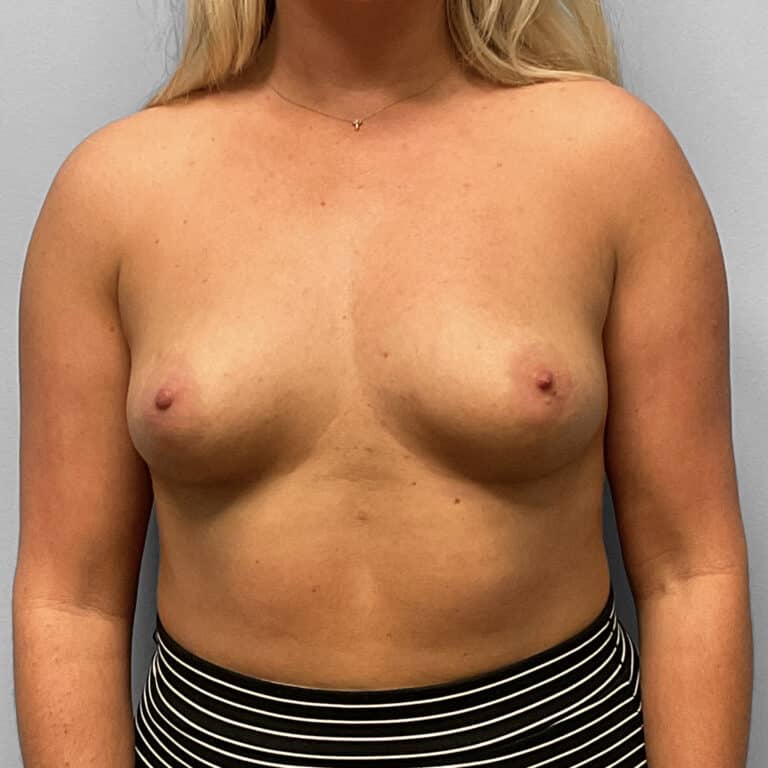 Before Image: Breast Augmentation – Dr. Tucker - front
