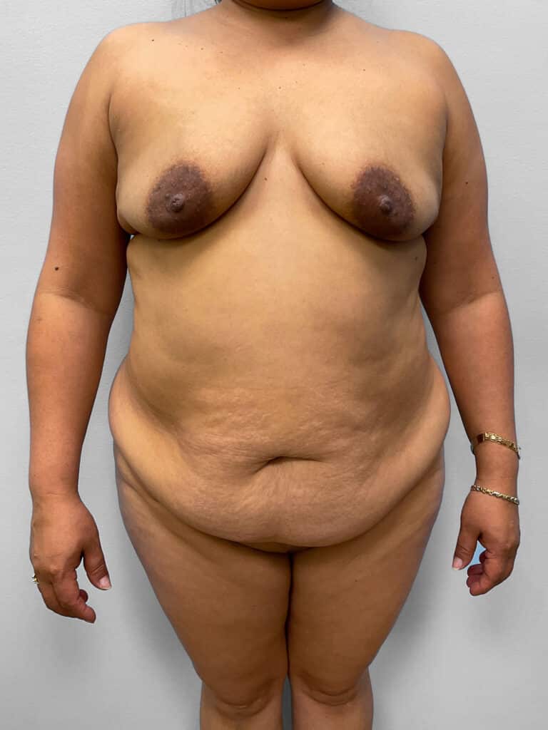 Before Image: Mommy Makeover – Dr. Tucker - front