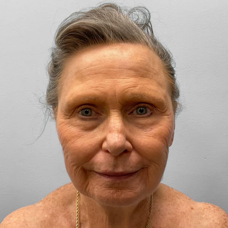 Before Image: Facelift – Dr. Tucker - front