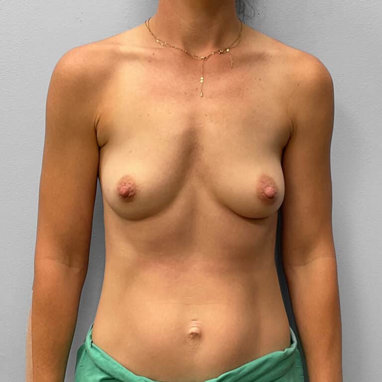 Before Image: Breast Augmentation – Dr. Tucker - front