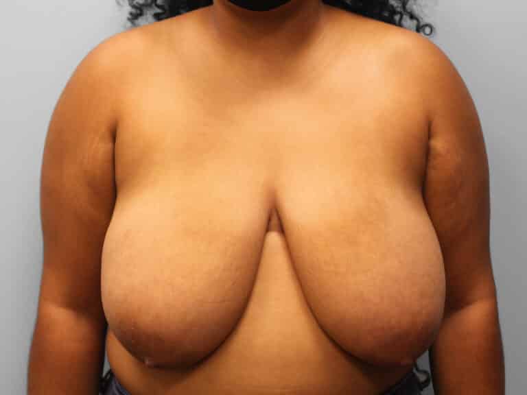 Before Image: Breast Reduction – Dr. Tucker - front