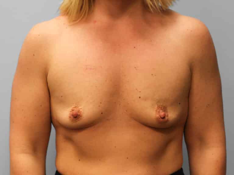 Before Image: Breast Augmentation – Dr. Tucker - front