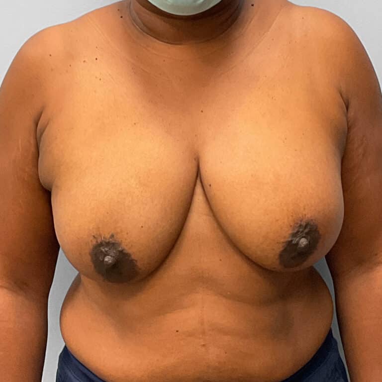 Before Image: Breast Augmentation – Dr. Tucker - front