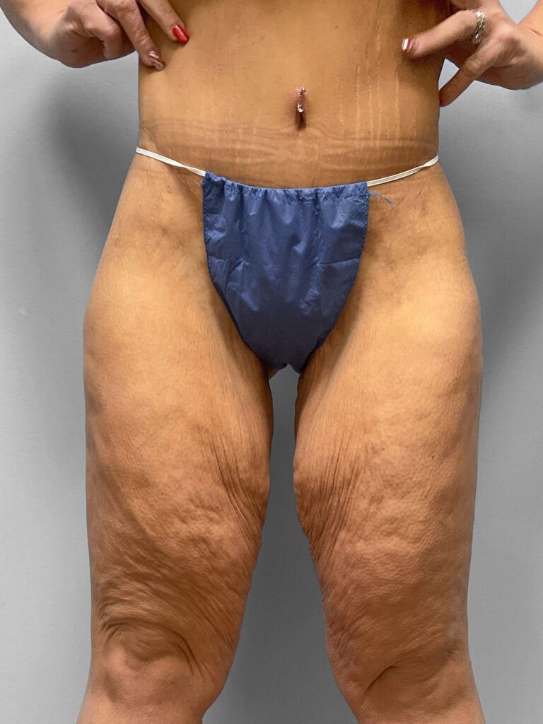 Before Image: Medial Thigh Lift – Dr. Tucker - front
