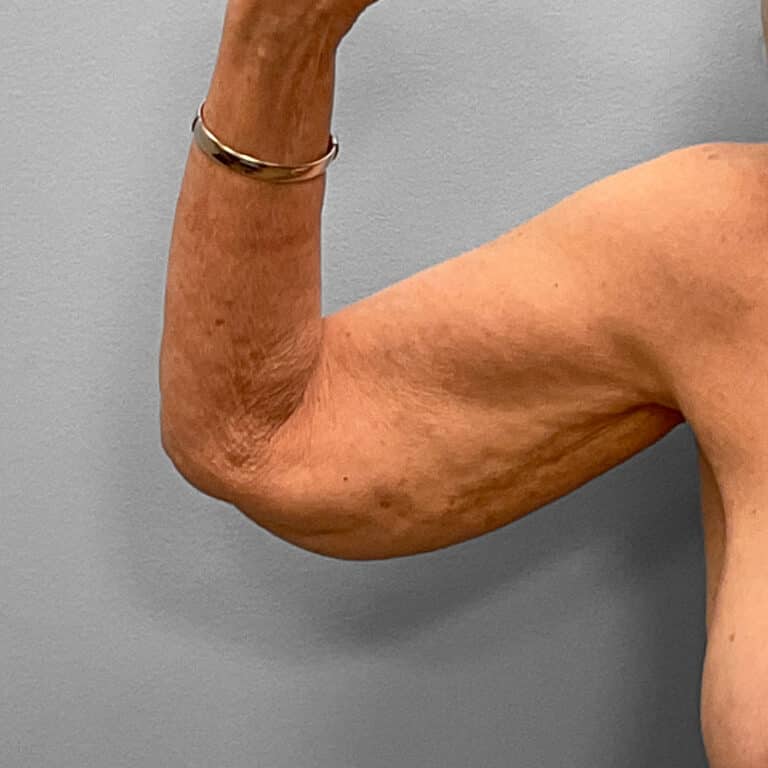 Before Image: Arm Lift – Dr. Tucker - front