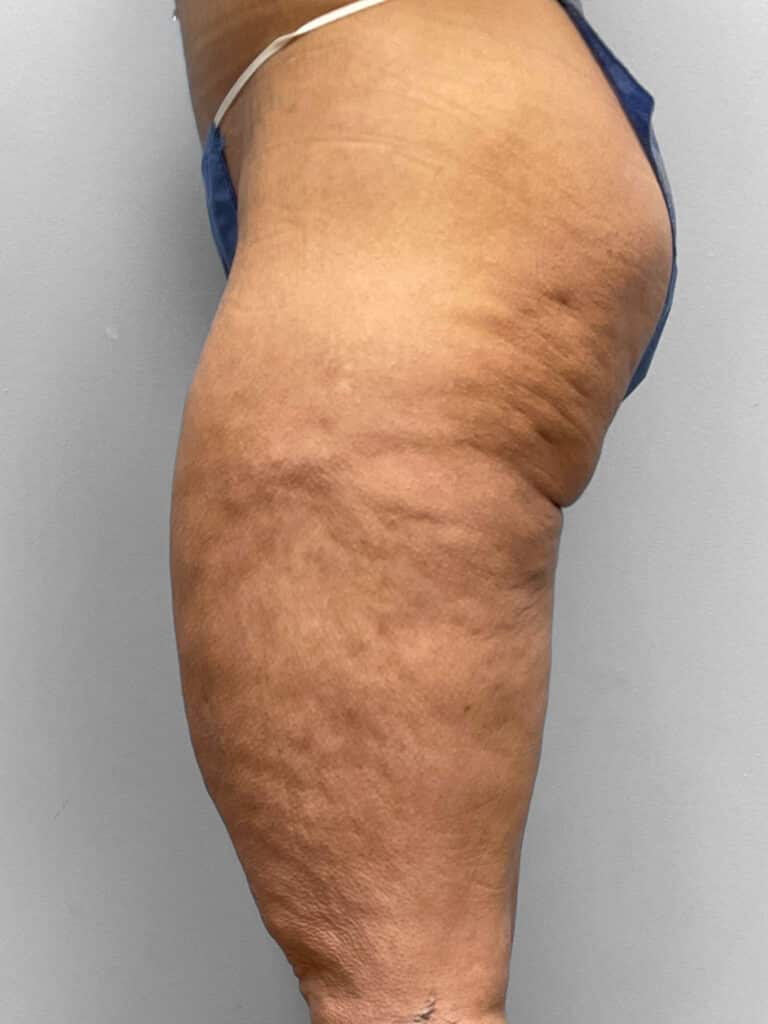 Before Image: Medial Thigh Lift – Dr. Tucker - left-side