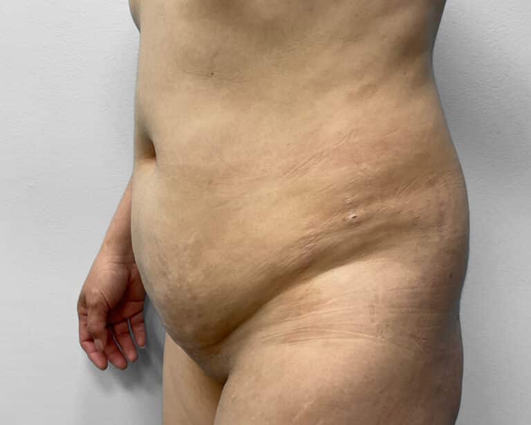 Before Image: Tummy Tuck, BBL, & Lipo – Dr. Tucker - left-front-oblique