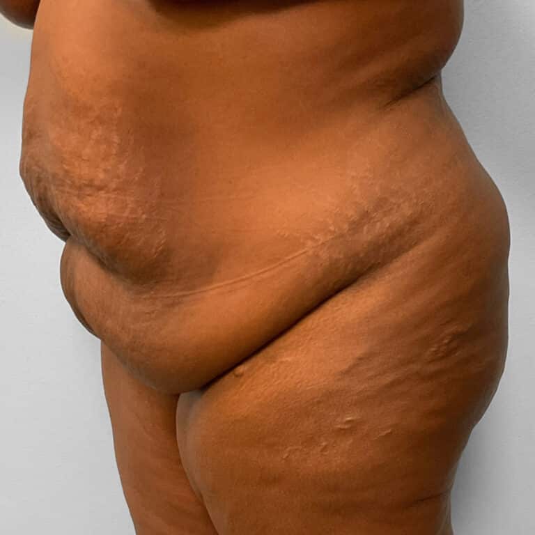 Before Image: Abdominoplasty & Lipo – Dr. Tucker - left-front-oblique