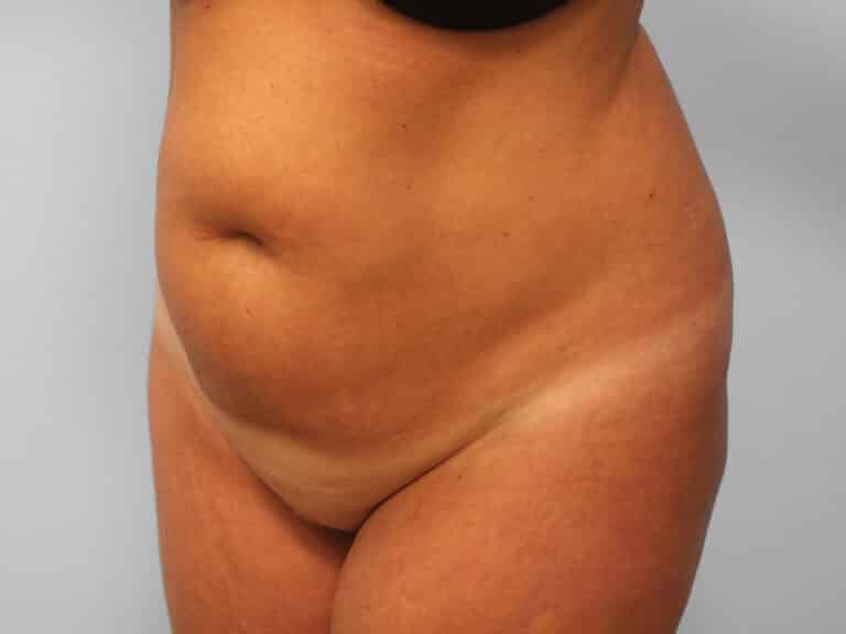 Before Image: Abdominoplasty & Lipo – Dr. Tucker - left-front-oblique
