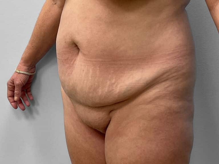 Before Image: Tummy Tuck & Lipo – Dr. Tucker - left-front-oblique
