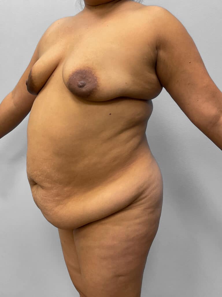 Before Image: Mommy Makeover – Dr. Tucker - left-front-oblique
