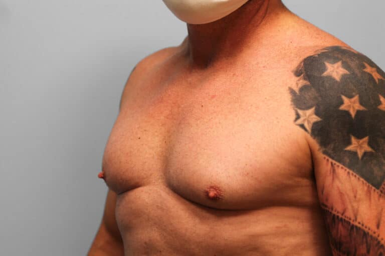 Before Image: Gynecomastia Surgery – Dr. Tucker - left-front-oblique