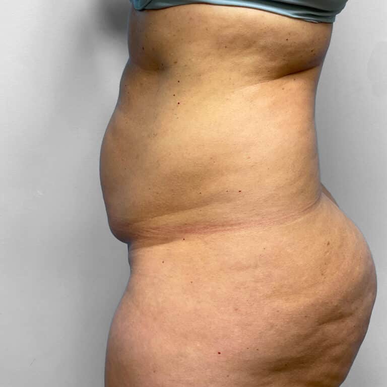 Before Image: Tummy Tuck & Lipo – Dr. Tucker - left-side