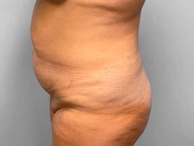 Before Image: Abdominoplasty & Lipo – Dr. Tucker - left-side