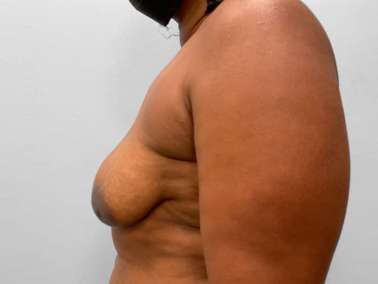 Before Image: Breast Augmentation & Lift – Dr. Tucker - left-side