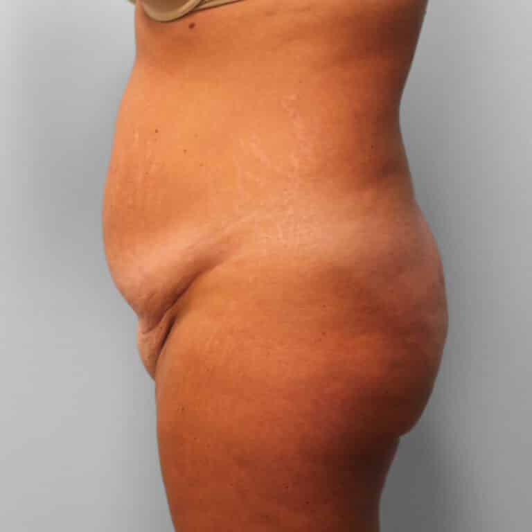 Before Image: Tummy Tuck & Lipo – Dr. Tucker - left-side
