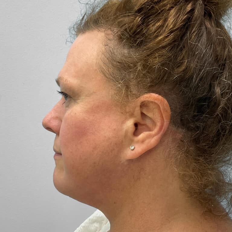 Before Image: Upper Blepharoplasty – Dr. Tucker - left-side
