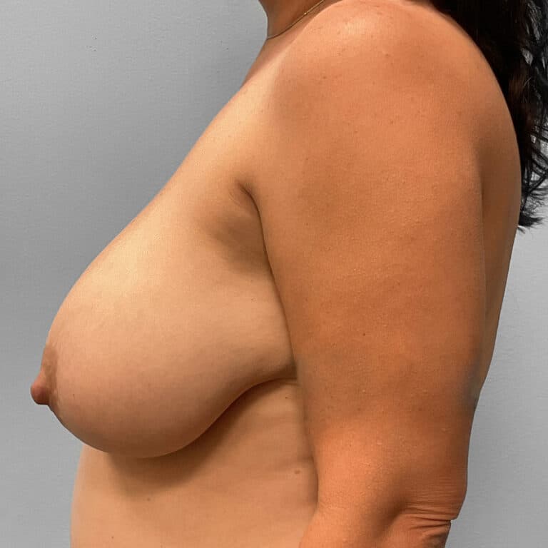 Before Image: Breast Reduction – Dr. Tucker - left-side