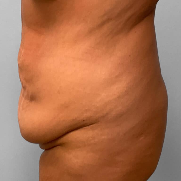 Before Image: Tummy Tuck & Lipo – Dr. Tucker - left-side