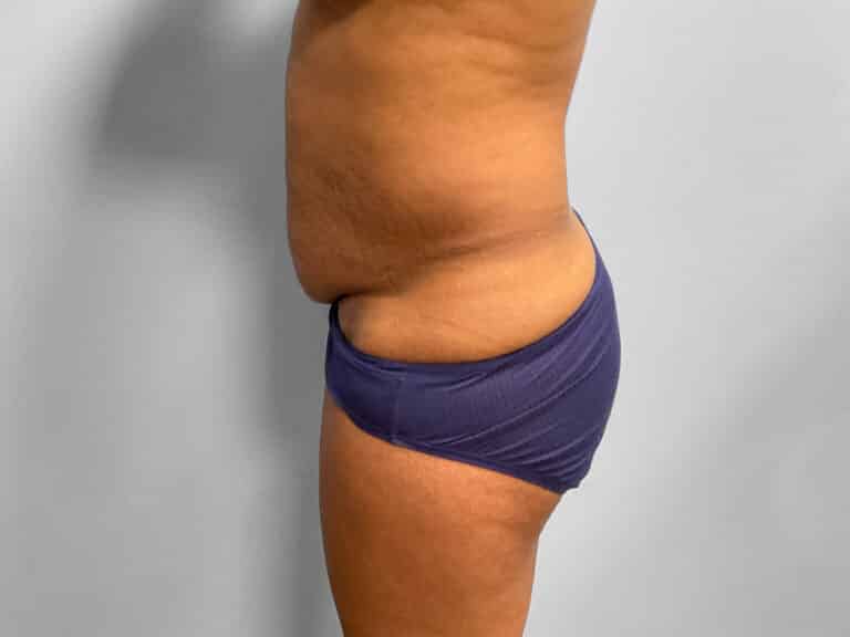 Before Image: Tummy Tuck & Lipo – Dr. Tucker - left-side