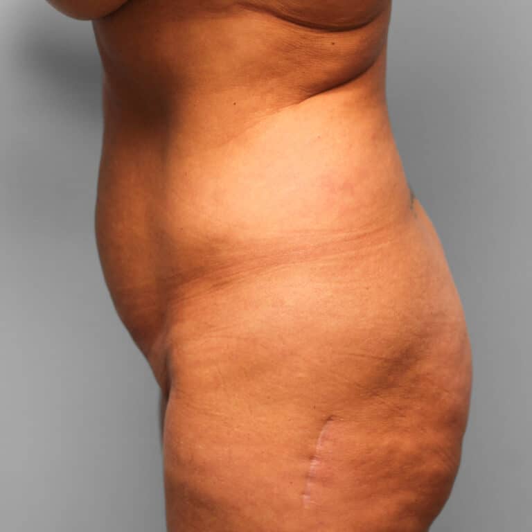 Before Image: Mini Tummy Tuck & Lipo – Dr. Tucker - left-side
