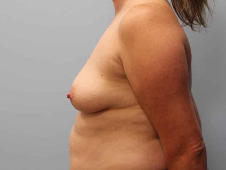 Before Image: Breast Augmentation – Dr. Tucker - left-side