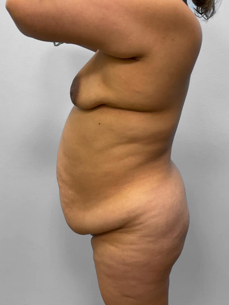 Before Image: Mommy Makeover – Dr. Tucker - left-side