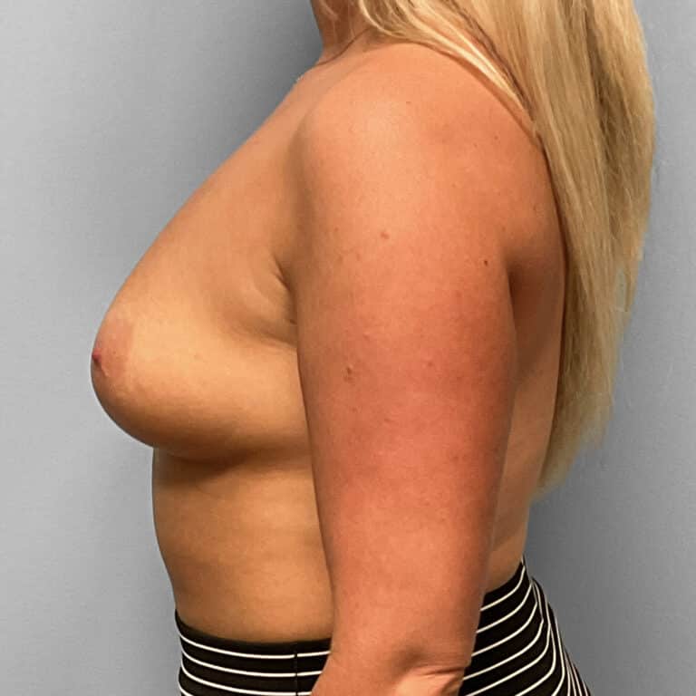 Before Image: Breast Augmentation – Dr. Tucker - left-side